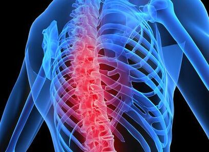 остеохондроз грудного отдела позвоночника